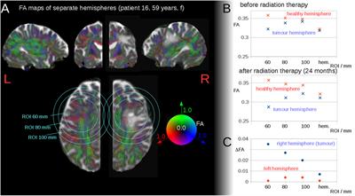 Cerebral Microstructural Alterations after Radiation Therapy in High-Grade Glioma: A Diffusion Tensor Imaging-Based Study